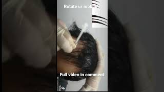 Microneedling hair growth procedure minor surgery [upl. by Peria]