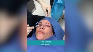 Upper Blepharoplasty Surgery with Tawny Kitaen [upl. by Wills]