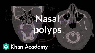 Nasal Polyp Removal Surgery [upl. by Nylaf]