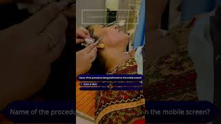 Subcision for Acne Scars  Acne Scar Treatment  Dr Himani Yadav  Cosmetic Surgeon In Gurgaon [upl. by Drusus]