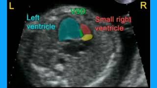 Tricuspid Atresia [upl. by Ocir998]