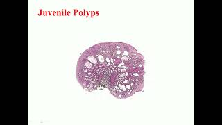 colonic polyps [upl. by Dlanger168]