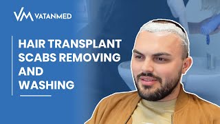 Hair Transplant Scabs Removing And Washing  VATANMED [upl. by Assiroc539]