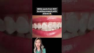 How to Prevent White Spots On Teeth After Braces [upl. by Milzie842]