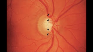 Normal Optic Disc Appearance [upl. by Veron]