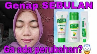 SEBULAN PAKAI ACNES INI KONDISI MUKA AKU [upl. by Rora]