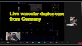 Vascular online training MOH venous duplex scan by Prof Erica Mendoza great case [upl. by Nahtam]