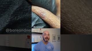 Derm reacts to super satisfying ingrown hairs ingrownhair satisfying [upl. by Ynnatirb]