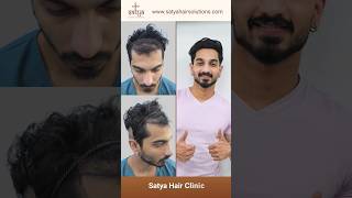 Hairline Transplant Hairline Regrowth Hair Loss  satya hairlinerestoration hairlinetransplant [upl. by Felty546]