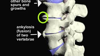 Degenerative Disc Disease of the Spine ALIF Part 1  Animation by Cal Shipley MD [upl. by Akialam927]