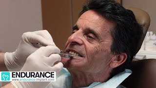 Prothèse amovible  Travail du dentiste et prothésiste  Dr SUBA Hongrie [upl. by Colb]