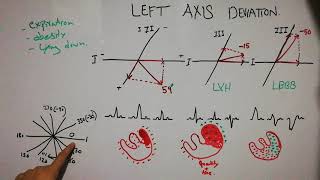 CVS physiology 34  Left axis deviation  left ventricular hypertrophy  left bundle branch block [upl. by Balmuth]