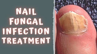 HOW TO TREAT FUNGAL NAIL INFECTION  TINEA UNGUIUM  ONYCHOMYCOSIS [upl. by Chappie]