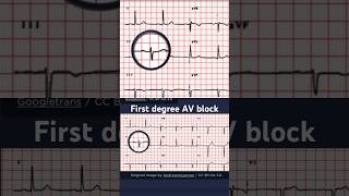 First Degree Atrioventricular Block ECG Example 2 [upl. by Kciredohr608]