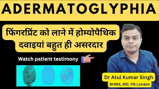 फिंगरप्रिंट्स की वापसी एक चमत्कारिक कहानी  A Miraculous Recovery from Adermatoglyphia [upl. by Nath]