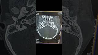 Acute Mastoiditis with Subperiosteal Abscess [upl. by Anneres]