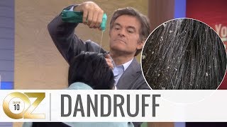 Quick and Easy Home Remedies For Dandruff [upl. by Capwell126]