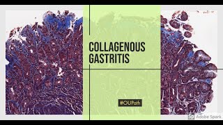 Collagenous gastritis [upl. by Cohe724]