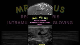 Rectus Femoris Intramuscular Degloving Injury [upl. by Jerrol]