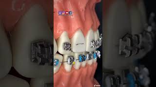 ¡SORPRENDENTE instalando BRACKETS metálicos [upl. by Ahsenyl669]