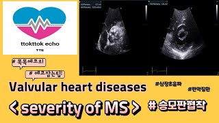 승모판협착 중증도 평가 mitral stenosis severity echocardiography 심장초음파 heart echo view 판막질환 승모판협착 [upl. by Adlih]