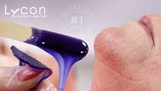 Goodbye Pesky Chin Hairs With LYCOJET Lavender Hot Wax  LYCON Cosmetics [upl. by Neeneg70]