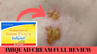 quotImiquad Cream Review Skin Wars and Wart Whispers 💪🌟 SkinSuperhero ImiquadUnveiledquot [upl. by Korney]