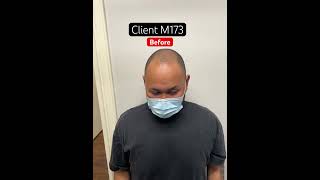 Client m173 before Micro hair tattooing smp scalpmicropigmentation edmonton [upl. by Iveel]