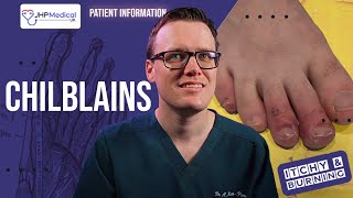 How To Get Rid Of CHILBLAINS Pernio Itchy Sores On Your Fingers And Toes  Doctor Explains [upl. by Alik783]