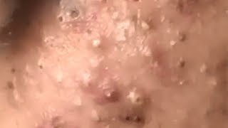 Huge Acne Pimples Blackheads Popping Up Satisfying with Oddly Calm Music [upl. by Irmina865]