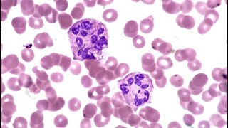 Haematology cases megaloblastic anemia [upl. by Latonia759]