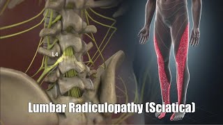 Lumbar Radiculopathy Sciatica [upl. by Meehsar]