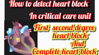 Heart block Atrioventricular block  AV block  ECG of heart block  mobitz type 1 and 2 [upl. by Ploch]