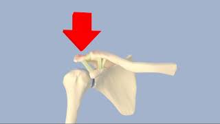 Acromioclavicular Separation [upl. by Kari]