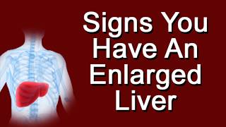 Signs You Have An Enlarged Liver [upl. by Adnert]