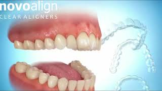 How NovoAlign Aligners move teeth [upl. by Acacia]