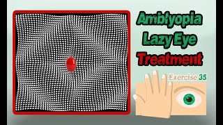 Amblyopia Lazy Eye Treatment Exercise 35  تمارين علاج كسل العين غمش العين الكسولة رقم 35 [upl. by Etnomaj]