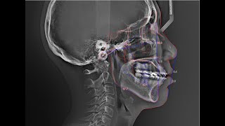 WillCeph Automated Cephalometric Analysis Software [upl. by Htessil]