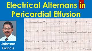 Electrical Alternans in Pericardial Effusion [upl. by Lexi]