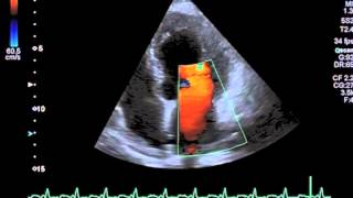 Doxorubicininduced Cardiotoxicity [upl. by Joete]