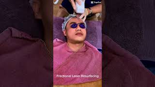 Fractional CO2 Laser resurfacing at RES Clinic acnescars fractionallaser [upl. by Akaenahs467]