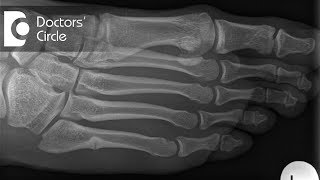 What should one do to speed up the recovery post surgery for Metatarsal Fracture  Dr Mohan M R [upl. by Vyse198]