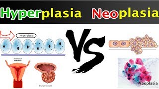 Neoplasia Vs Hyperplasia  Clear Comparison [upl. by Junius]