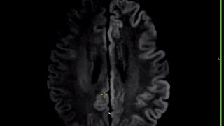 neuroradiology masterclass P4 [upl. by Offen]