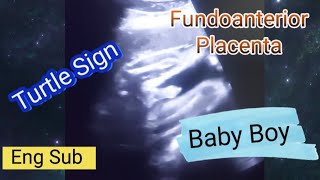 Fundoanterior placenta means baby boygirl  28 weeks pregnant  genderreveal scan  Turtle sign [upl. by Sldney]