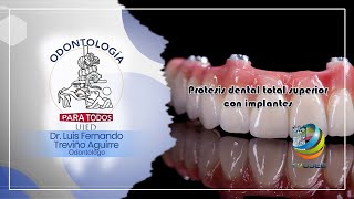 Odontología para todos Prótesis dental total superior con implantes [upl. by Llertrac]