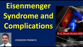 Eisenmenger Syndrome and Complications [upl. by Gardas192]