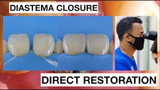 Diastema Closure with Direct Bonding Composite Restoration  General Dentist Griya RR [upl. by Melleta]