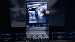 intussusception by ultrasound and evaluation تشخيص وشرح الحاله مباشر من العياده [upl. by Ellingston]