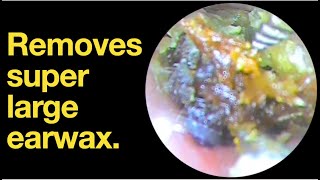 Removes super large earwax ear wax removal  ear cleaning  ASMR  relaxation  relax [upl. by Hanas43]